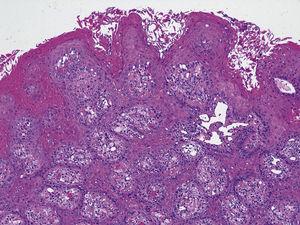 lymphomatoid papillomatosis patológia